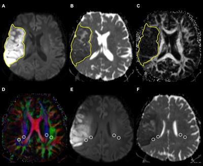Glymphatic Dysfunction in Patients With Ischemic Stroke